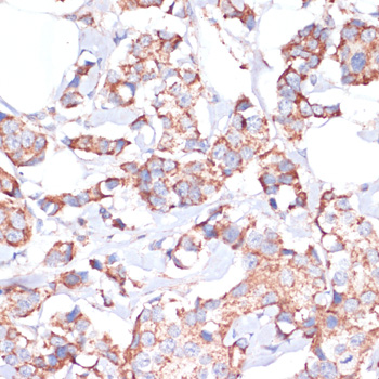 Immunohistochemistry of paraffin-embedded Human breast cancer using UBE2O Polyclonal Antibody at dilution of  1:100 (40x lens).