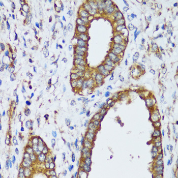 Immunohistochemistry of paraffin-embedded Human uterine cancer using MAPK1/MAPK3 Polyclonal Antibody at dilution of  1:200 (40x lens).