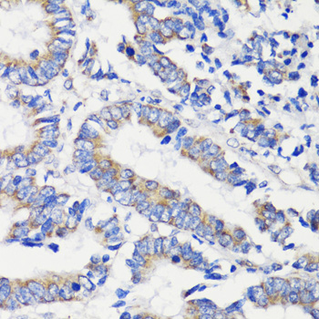 Immunohistochemistry of paraffin-embedded Human colon carcinoma using DEPDC6 Polyclonal Antibody at dilution of  1:200 (40x lens).