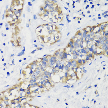 Immunohistochemistry of paraffin-embedded Human breast cancer using DEPDC6 Polyclonal Antibody at dilution of  1:200 (40x lens).