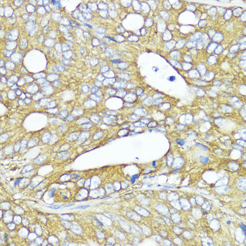 Immunohistochemistry of paraffin-embedded Human colon carcinoma using MLKL Polyclonal Antibody at dilution of  1:200 (40x lens).