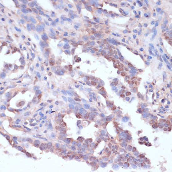 Immunohistochemistry of paraffin-embedded Human lung cancer using CARTPT Polyclonal Antibody at dilution of  1:100 (40x lens).