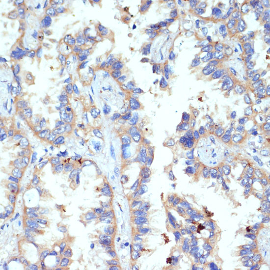 Immunohistochemistry of paraffin-embedded Human lung cancer using CD47 Polyclonal Antibody at dilution of  1:200 (40x lens).
