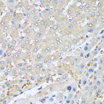 Immunohistochemistry of paraffin-embedded Human liver cancer using PPBP Polyclonal Antibody at dilution of  1:100 (40x lens).