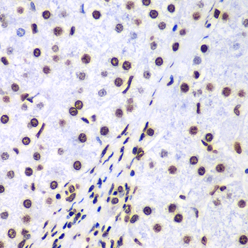 Immunohistochemistry of paraffin-embedded Human liver cancer using Histone H3 Polyclonal Antibody at dilution of  1:100 (40x lens).