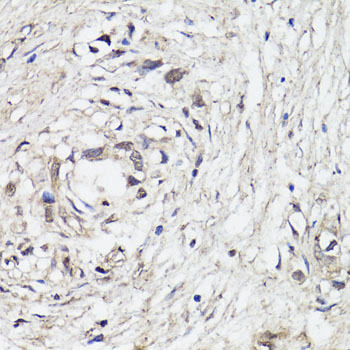 Immunohistochemistry of paraffin-embedded Human gastric cancer using c-Fos Polyclonal Antibody at dilution of  1:150 (40x lens).