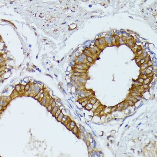Immunohistochemistry of paraffin-embedded Human mammary cancer using WNT1 Polyclonal Antibody at dilution of  1:100 (40x lens).
