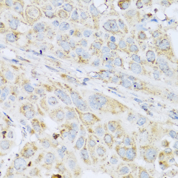 Immunohistochemistry of paraffin-embedded Human esophageal cancer using LYZ Polyclonal Antibody at dilution of  1:100 (40x lens).