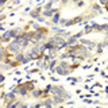 Immunohistochemistry of paraffin-embedded Human colon carcinoma using APLP1 Polyclonal Antibody at dilution of  1:100 (40x lens).