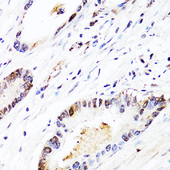 Immunohistochemistry of paraffin-embedded Human colon carcinoma using FGF12 Polyclonal Antibody at dilution of  1:150 (40x lens).