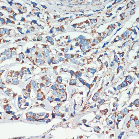 Immunohistochemistry of paraffin-embedded Human breast cancer using APC Polyclonal Antibody at dilution of  1:200 (40x lens).