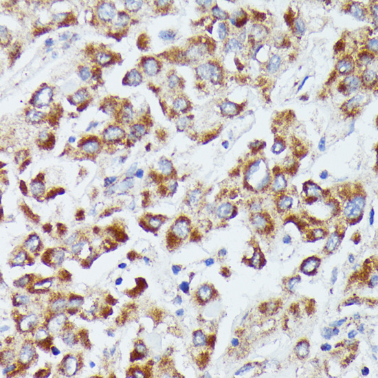 Immunohistochemistry of paraffin-embedded Human liver cancer using DUT Polyclonal Antibody at dilution of  1:100 (40x lens).
