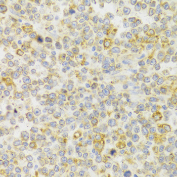 Immunohistochemistry of paraffin-embedded Human B cell lymphoma using KISS1R Polyclonal Antibody at dilution of  1:100 (40x lens).