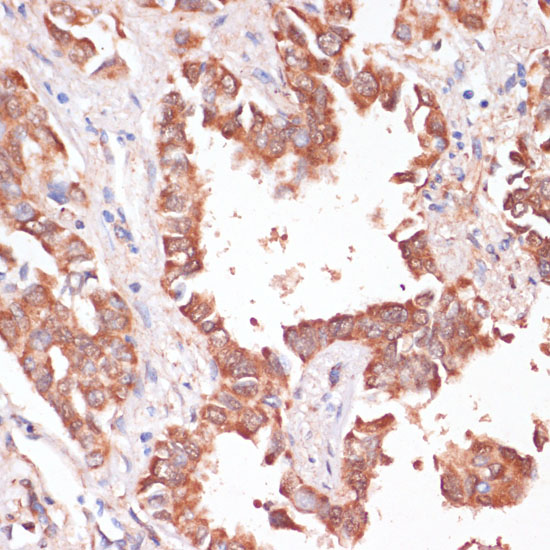 Immunohistochemistry of paraffin-embedded Human lung cancer using KCNH2 Polyclonal Antibody at dilution of  1:100 (40x lens).