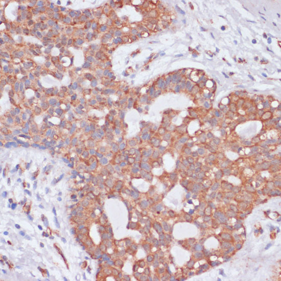 Immunohistochemistry of paraffin-embedded Human breast cancer using KCNH2 Polyclonal Antibody at dilution of  1:100 (40x lens).