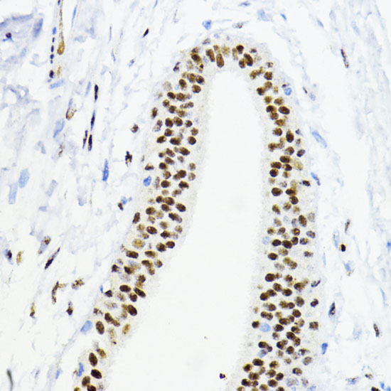 Immunohistochemistry of paraffin-embedded Human mammary cancer using ZEB1 Polyclonal Antibody at dilution of  1:200 (40x lens).
