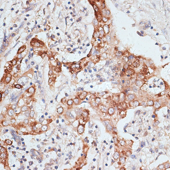 Immunohistochemistry of paraffin-embedded Human liver cancer using PIGR Polyclonal Antibody at dilution of  1:100 (40x lens).