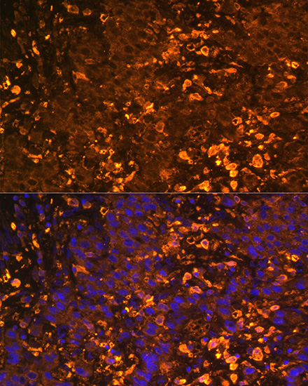 Immunofluorescence analysis of Human liver cancer using UGT1A1 Polyclonal Antibody at dilution of  1:100. Blue: DAPI for nuclear staining.