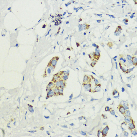Immunohistochemistry of paraffin-embedded Human mammary cancer using AKT1S1 Polyclonal Antibody at dilution of  1:200 (40x lens).