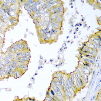 Immunohistochemistry of paraffin-embedded Human colon carcinoma using KRBOX4 Polyclonal Antibody at dilution of  1:200 (40x lens).