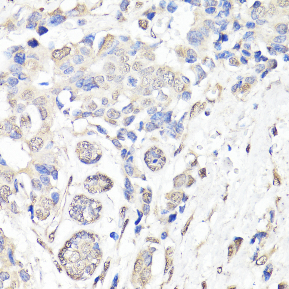 Immunohistochemistry of paraffin-embedded Human breast cancer using BAP1 Polyclonal Antibody at dilution of  1:150 (40x lens).