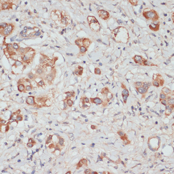 Immunohistochemistry of paraffin-embedded Human liver cancer using TES Polyclonal Antibody at dilution of  1:100 (40x lens).