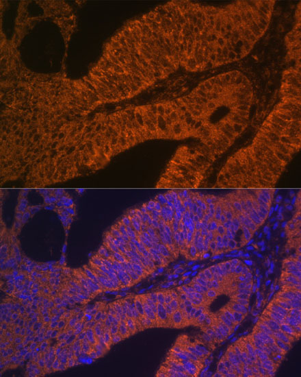 Immunofluorescence analysis of Human colon carcinoma using RAB5B Polyclonal Antibody at dilution of  1:100. Blue: DAPI for nuclear staining.