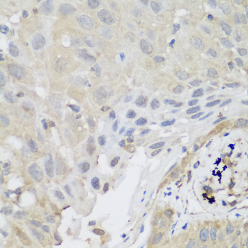 Immunohistochemistry of paraffin-embedded Human lung cancer using SH3GLB2 Polyclonal Antibody at dilution of  1:200 (40x lens).