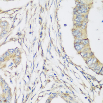 Immunohistochemistry of paraffin-embedded Human colon carcinoma using SH3GLB2 Polyclonal Antibody at dilution of  1:200 (40x lens).