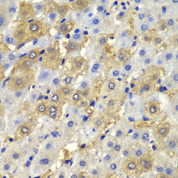 Immunohistochemistry of paraffin-embedded Human liver damage using Desmoplakin Polyclonal Antibody at dilution of  1:100 (40x lens).