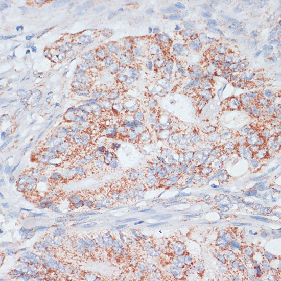 Immunohistochemistry of paraffin-embedded Human colon carcinoma using Desmoplakin Polyclonal Antibody at dilution of  1:100 (40x lens).