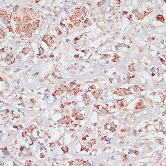 Immunohistochemistry of paraffin-embedded Human breast cancer using Desmoplakin Polyclonal Antibody at dilution of  1:100 (40x lens).