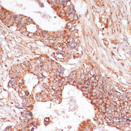 Immunohistochemistry of paraffin-embedded Human colon carcinoma using MAP2K3 Polyclonal Antibody at dilution of  1:100 (40x lens).