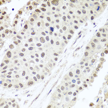 Immunohistochemistry of paraffin-embedded Human lung cancer using ALKBH4 Polyclonal Antibody at dilution of  1:100 (40x lens).