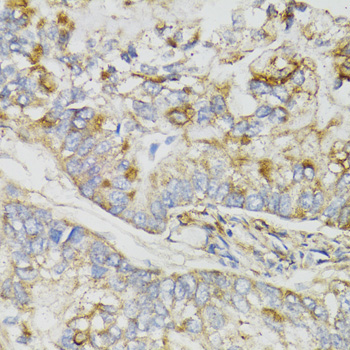 Immunohistochemistry of paraffin-embedded Human gastric cancer using NDUFS7 Polyclonal Antibody at dilution of  1:100 (40x lens).