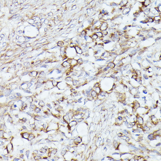 Immunohistochemistry of paraffin-embedded Human oophoroma using ACAT2 Polyclonal Antibody at dilution of  1:100 (40x lens).