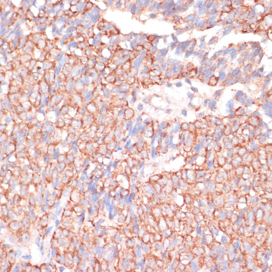 Immunohistochemistry of paraffin-embedded Human oophoroma using ACAT2 Polyclonal Antibody at dilution of  1:100 (40x lens).