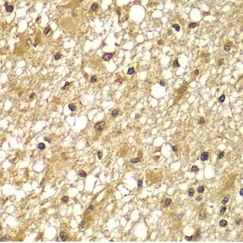 Immunohistochemistry of paraffin-embedded Human brain cancer using PIK3R3 Polyclonal Antibody at dilution of  1:100 (40x lens).