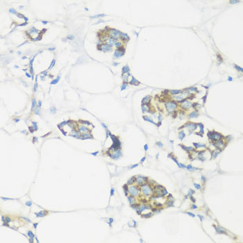 Immunohistochemistry of paraffin-embedded Human mammary cancer using NMT1 Polyclonal Antibody at dilution of  1:100 (40x lens).