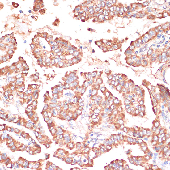 Immunohistochemistry of paraffin-embedded Human thyroid cancer using FRMD6 Polyclonal Antibody at dilution of  1:100 (40x lens).