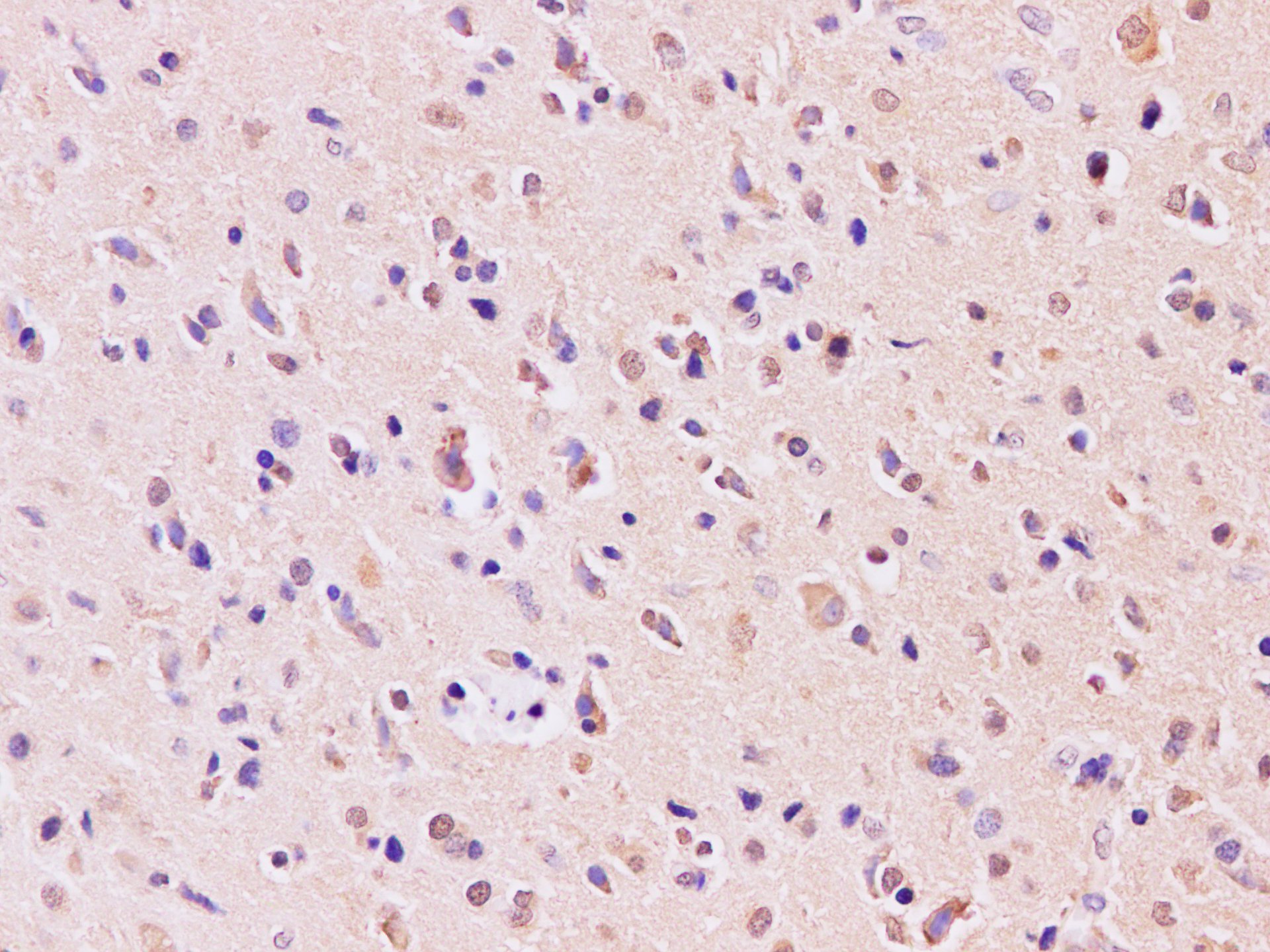 Immunohistochemistry of paraffin-embedded human gliomas using RAB5A Polyclonal Antibody at dilution of 1:200