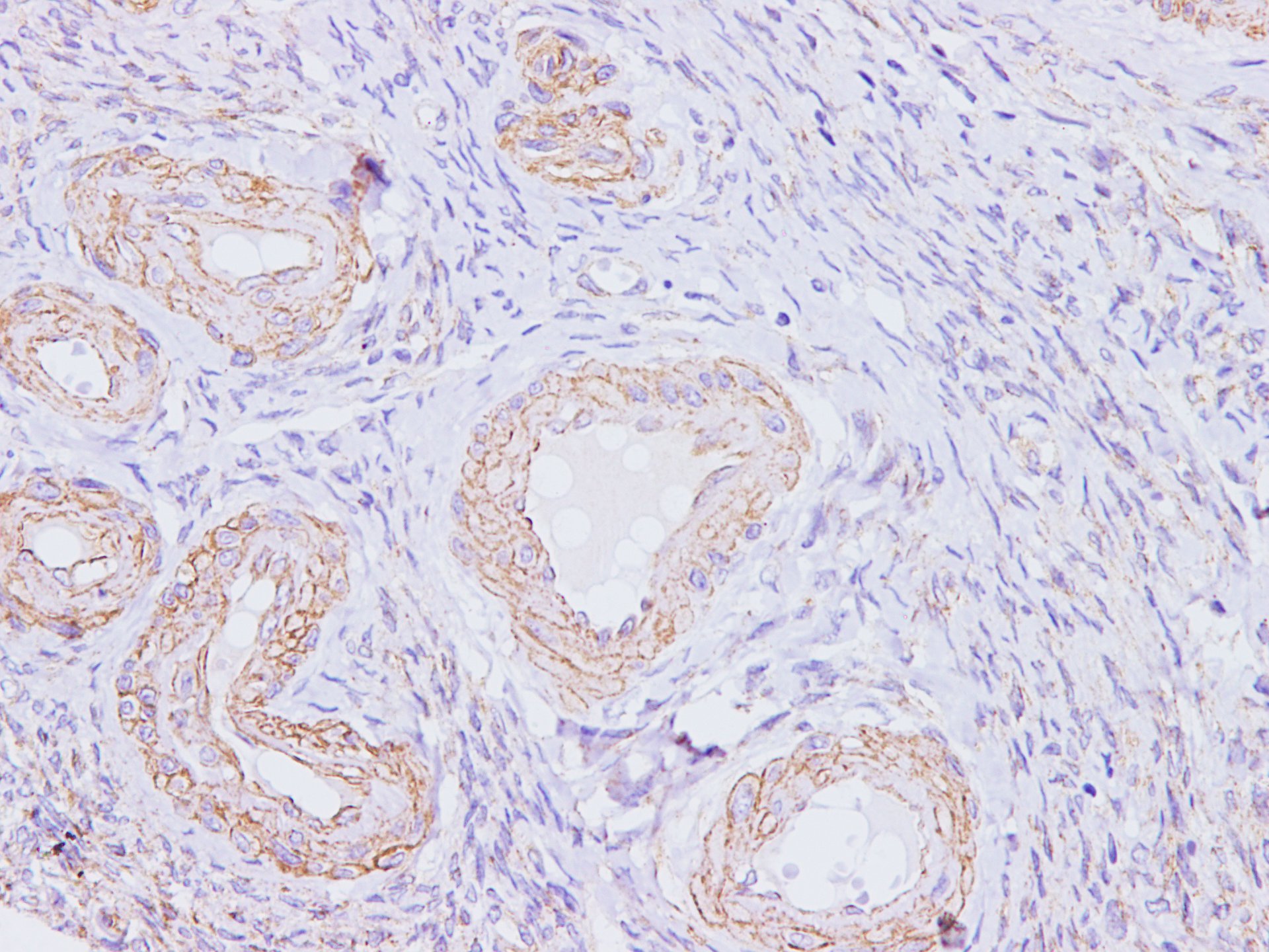 Immunohistochemistry of paraffinembedded Human ovarian  using p16 Polyclonal Antibody at dilution of 1:100