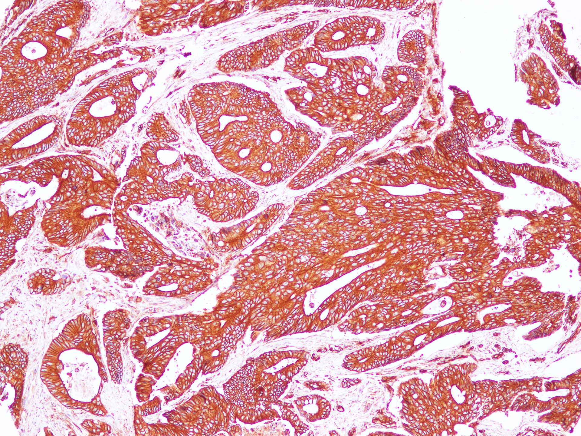 Immunohistochemistry of paraffin-embedded Human carcinoma of Colon using Sptan1 Polyclonal Antibody at dilution of 1:100（100×）