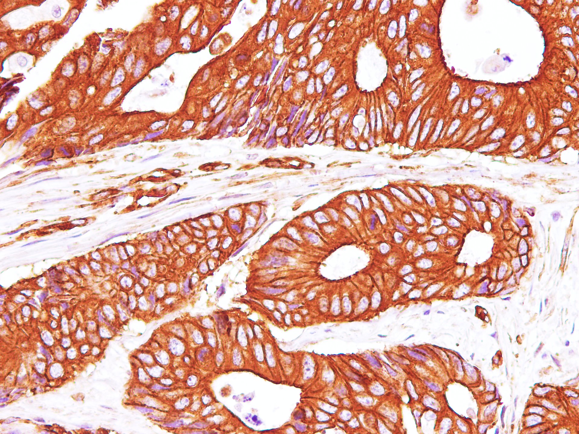 Immunohistochemistry of paraffin-embedded Human carcinoma of Colon using Sptan1 Polyclonal Antibody at dilution of 1:100（400×）