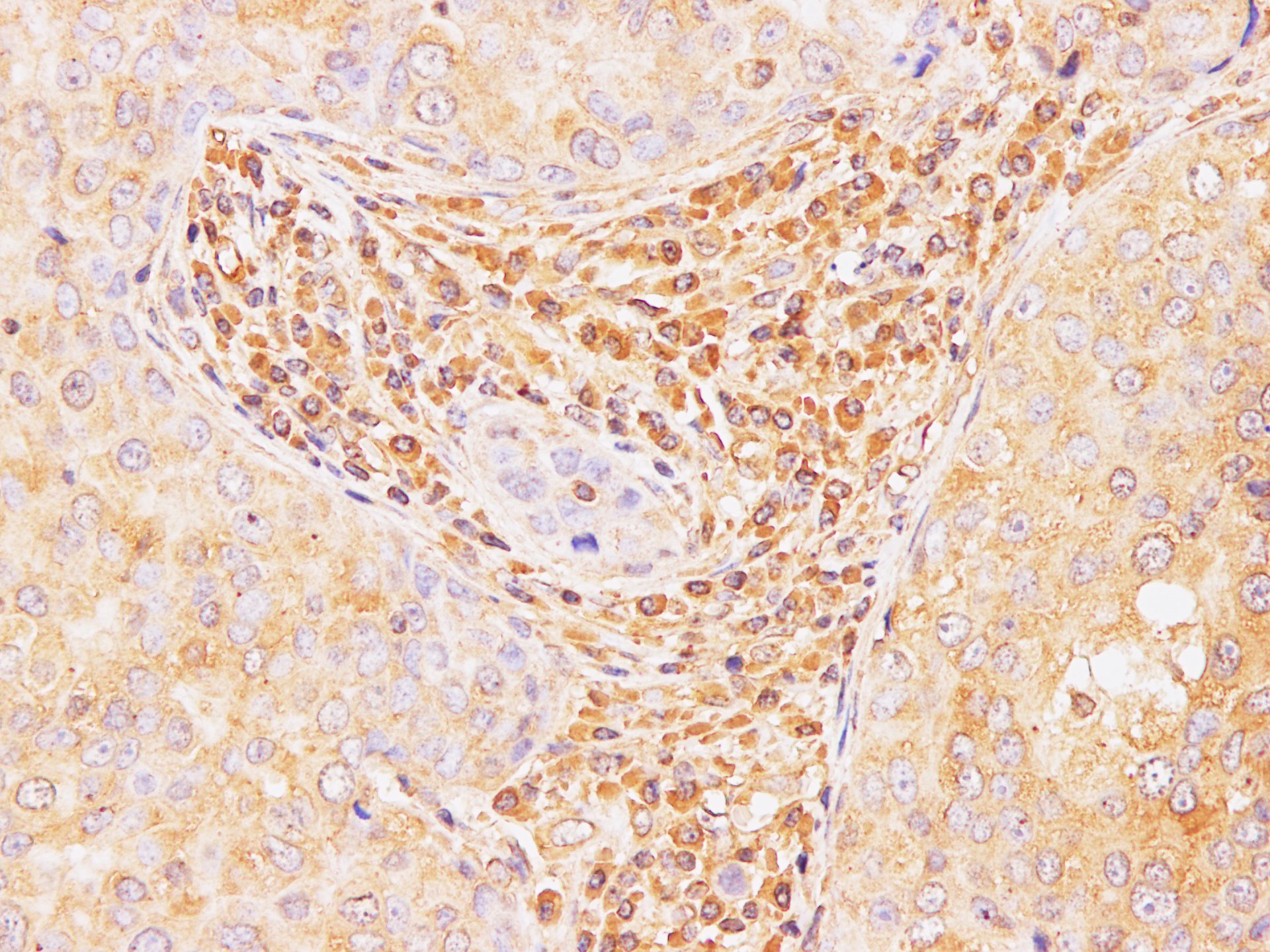 Immunohistochemistry of paraffin-embedded Human breast cancer using Il2 Polyclonal Antibody at dilution of 1:100