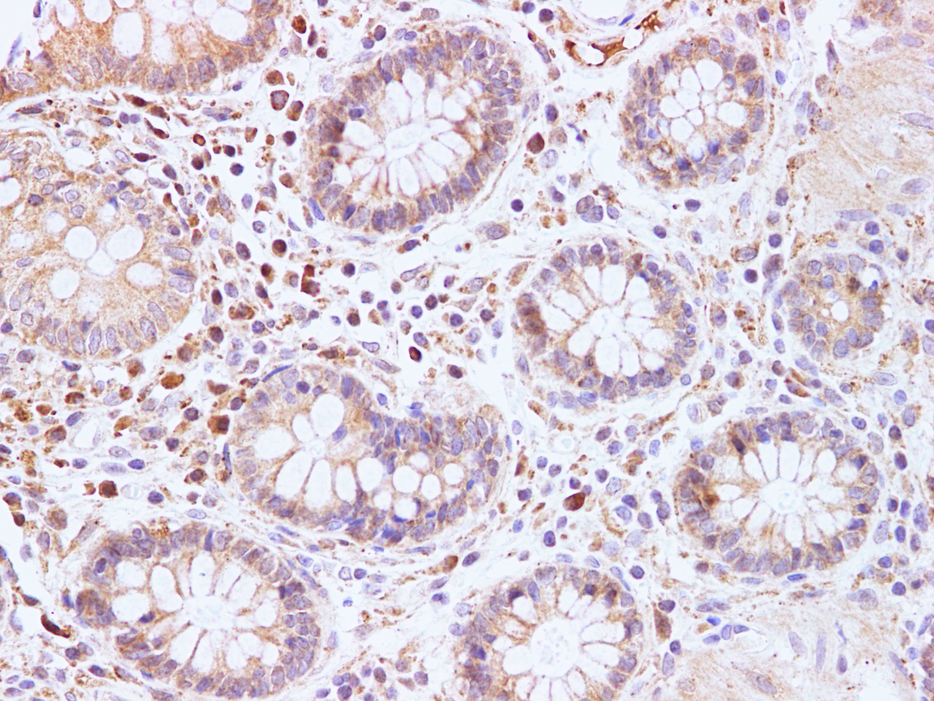 Immunohistochemistry of paraffin-embedded Human colon  using BRCA2 Polyclonal Antibody at dilution of 1:100