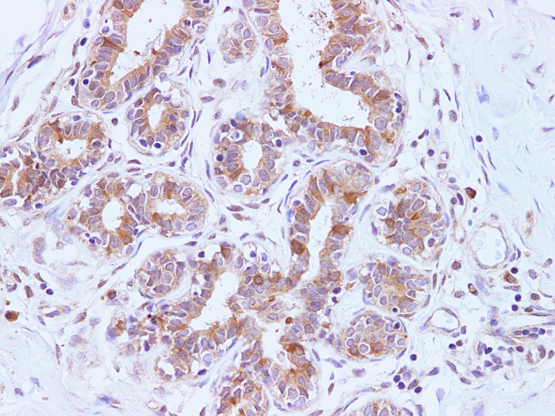 Immunohistochemistry of paraffin-embedded Human breast  using BRCA2 Polyclonal Antibody at dilution of 1:100