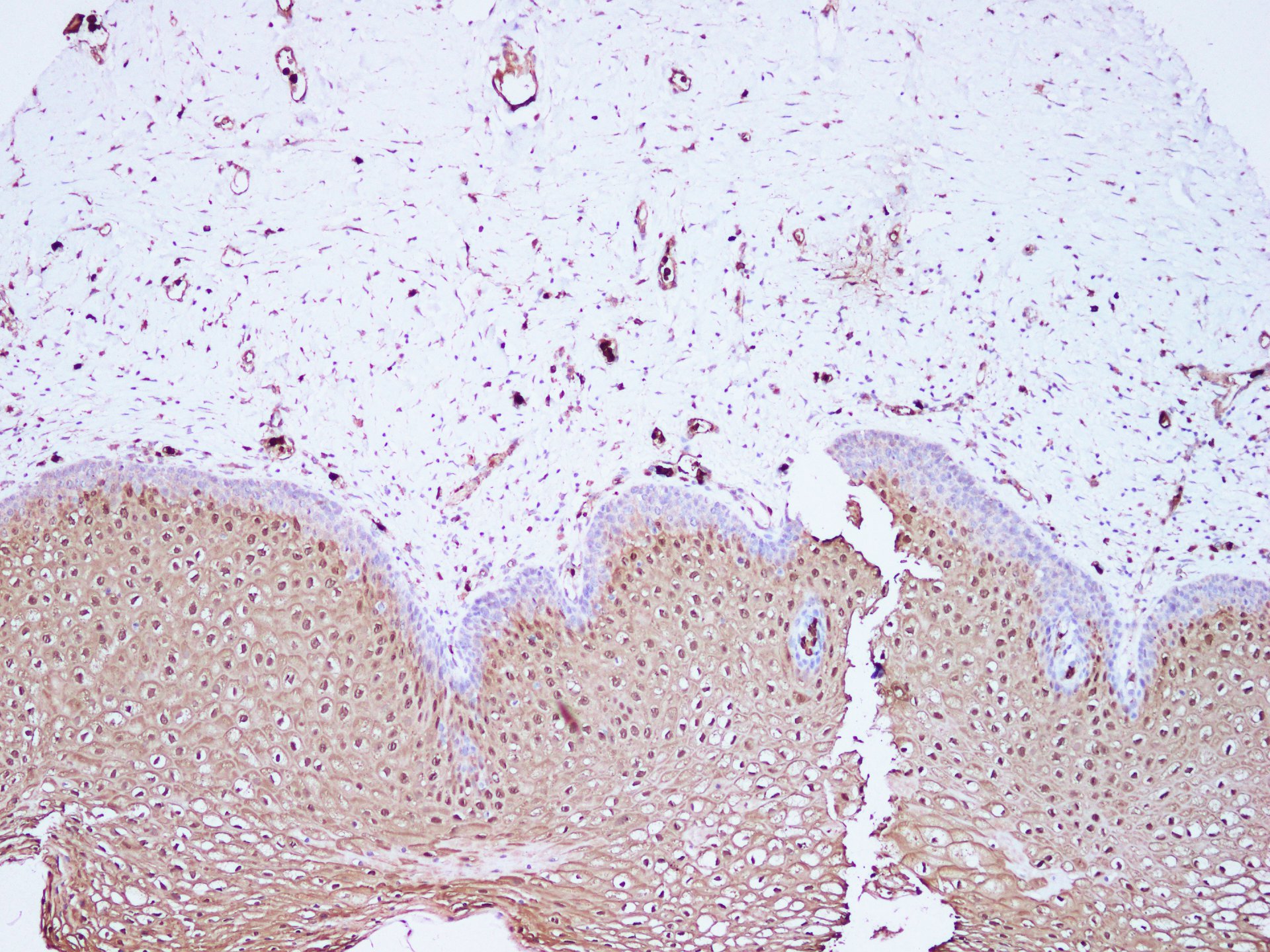 Immunohistochemistry of paraffin-embedded Human cervix using S100A8 Polyclonal Antibody at dilution of 1:100(100×)