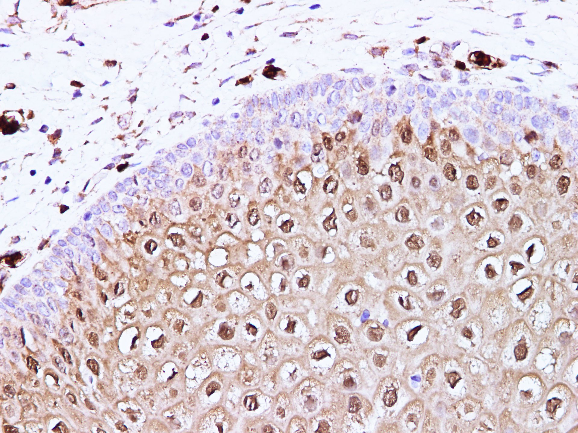 Immunohistochemistry of paraffin-embedded Human cervix using S100A8 Polyclonal Antibody at dilution of 1:100(400×)