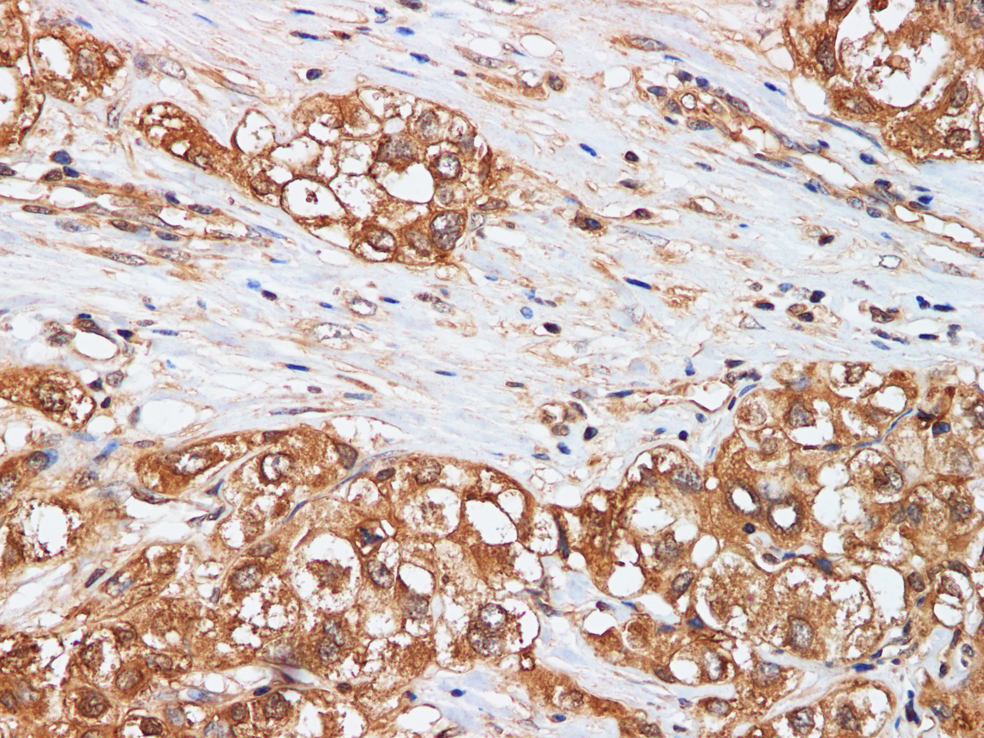 Immunohistochemistry of paraffin-embedded Human liver cancer  using AFP Polyclonal Antibody at dilution of 1:50